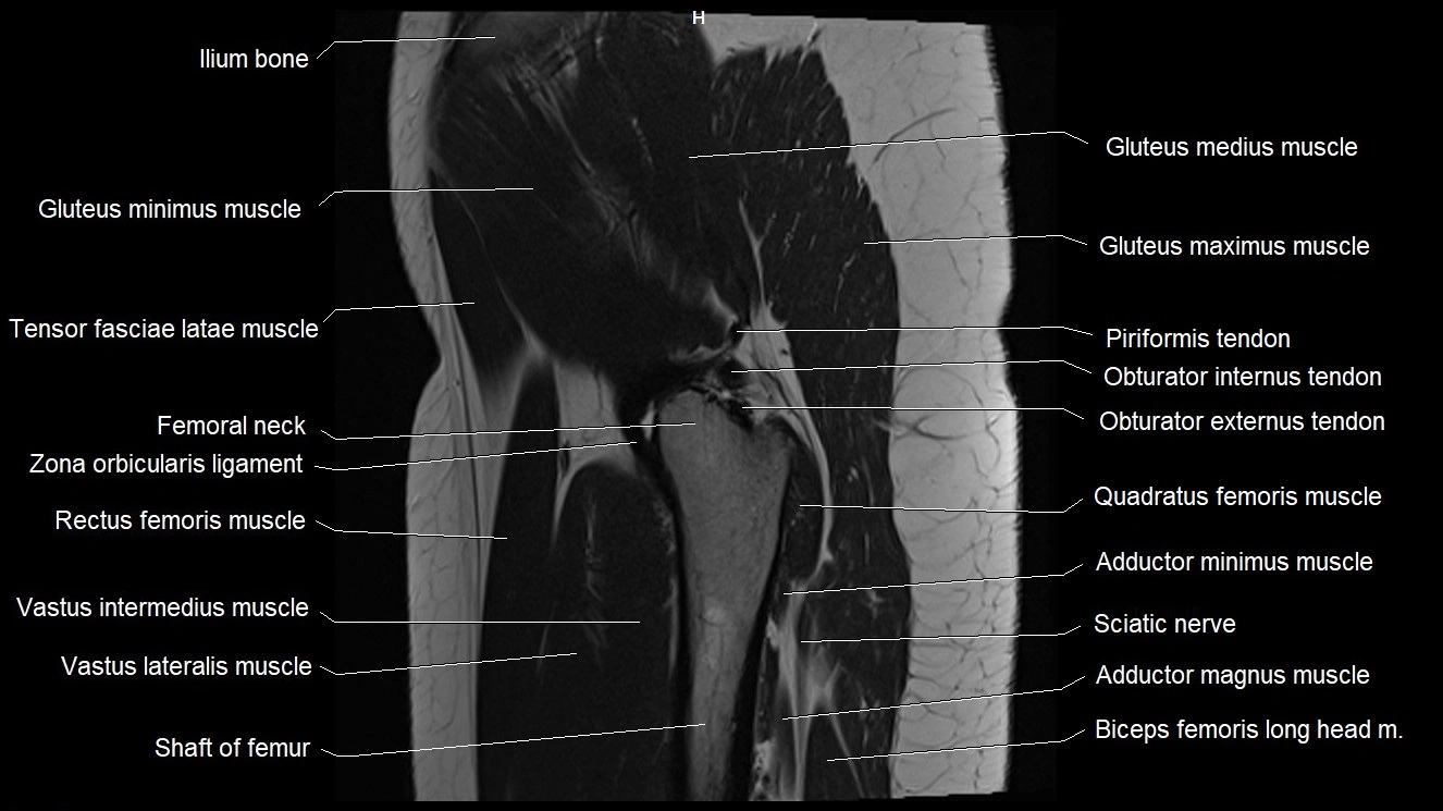 Hip sagittal cross sectional anatomy image 11.webp